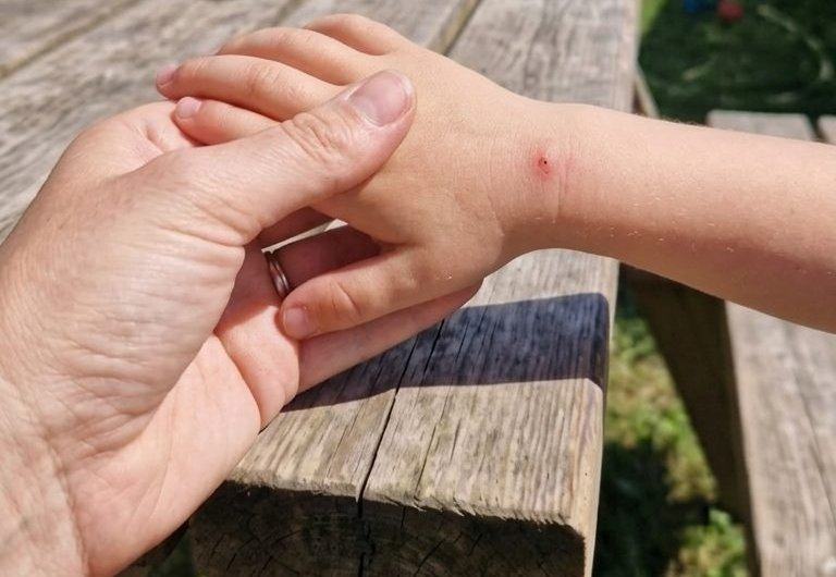 Mano di un genitore che tiene la mano di un bambino con una puntura di zanzara