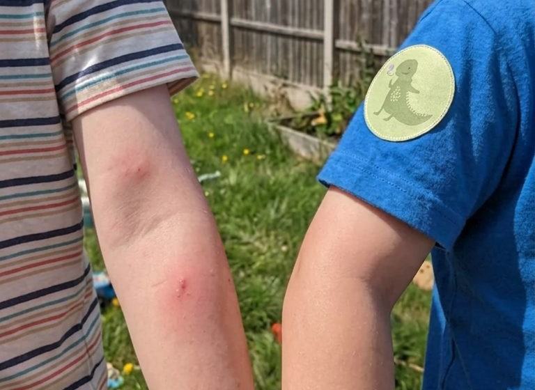 Le braccia di due bambini, uno pieno di punture e uno protetto